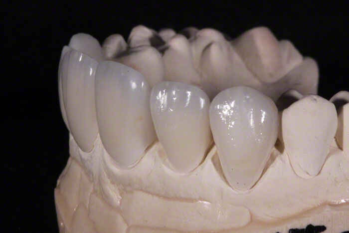 Why Feldspathic Veneers Still Lead in Premium Esthetic Cases
