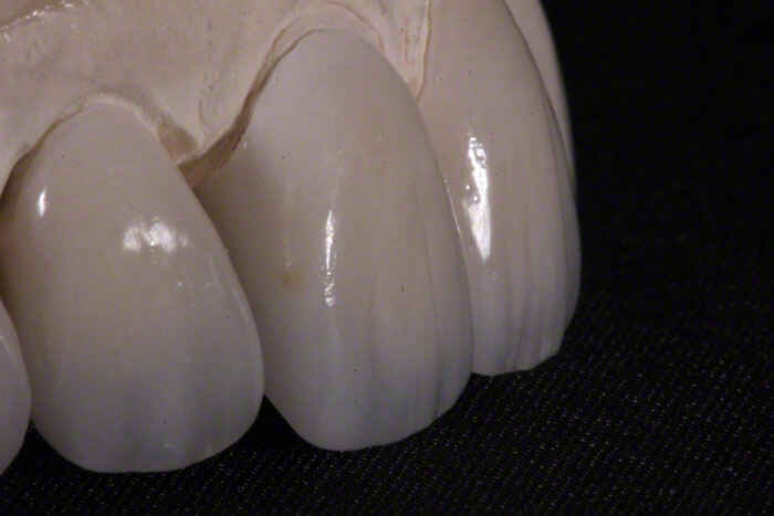 Why Feldspathic Veneers Still Lead in Premium Esthetic Cases