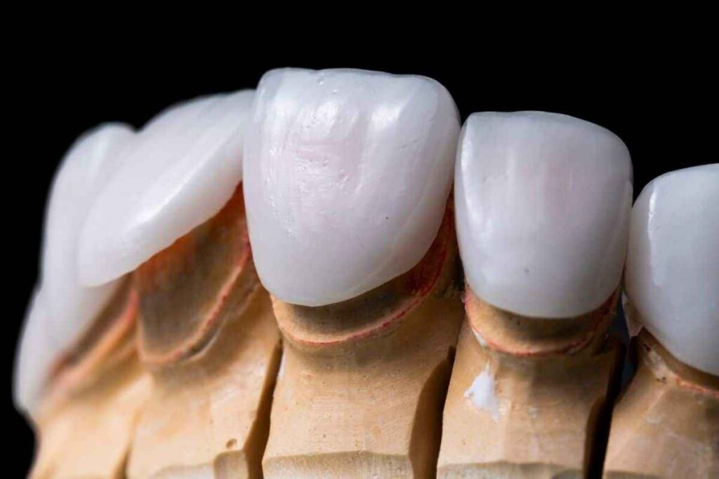 Why Feldspathic Veneers Still Lead in Premium Esthetic Cases