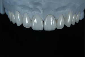 Can Veneers Be Re-Polished to Restore Their Original Esthetics