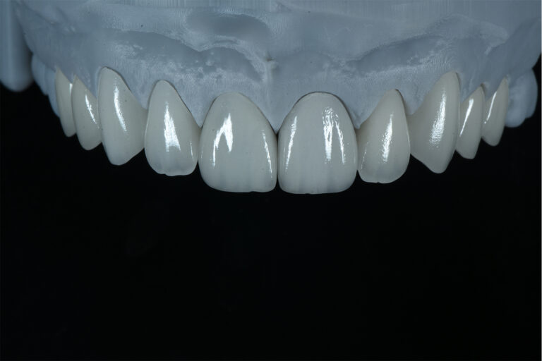 Can Veneers Be Re-Polished to Restore Their Original Esthetics