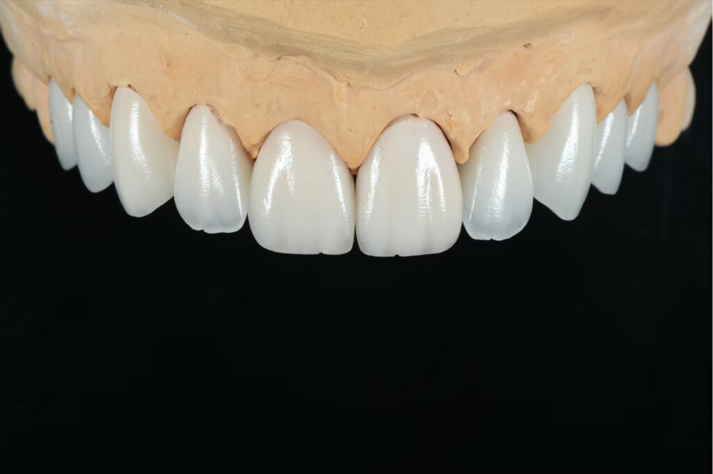 Can Veneers Be Re-Polished to Restore Their Original Esthetics