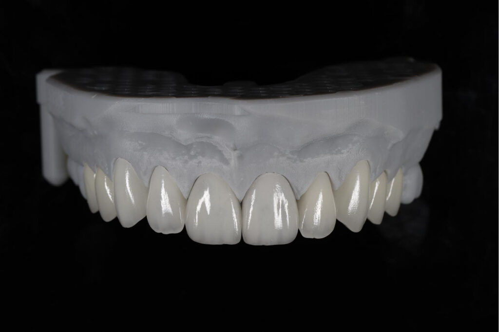 Can Veneers Be Re-Polished to Restore Their Original Esthetics