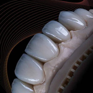 E.max Veneers