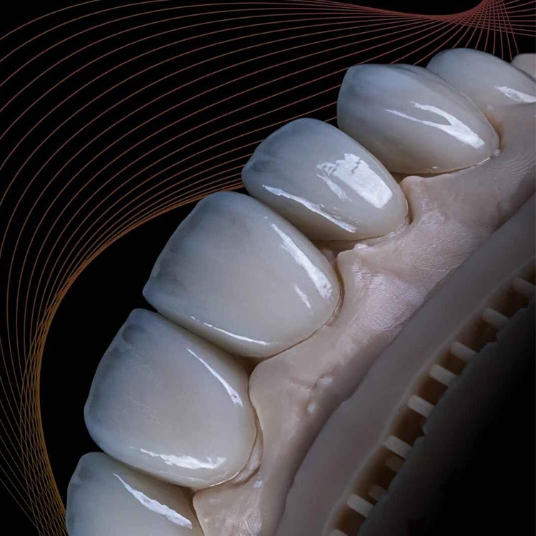 E.max Veneers