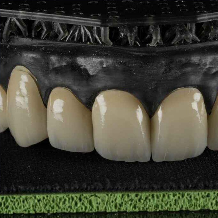 E.max Veneers