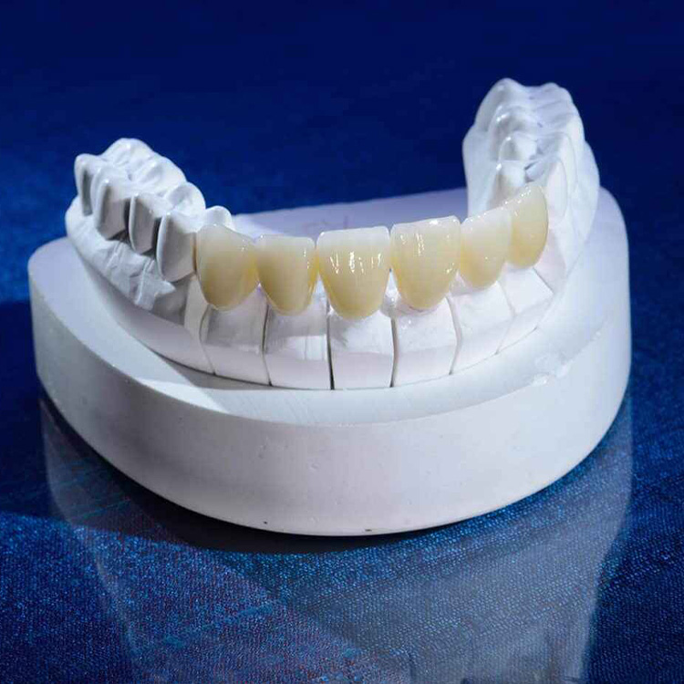 E.max Veneers