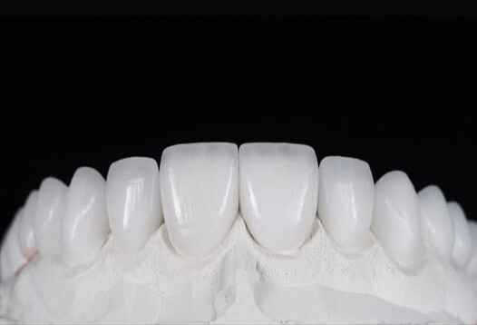 E.max vs Feldspathic Veneers for Ultra-Thin Esthetic Cases