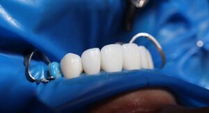 How Veneer Width-to-Length Ratio Changes Smile Character