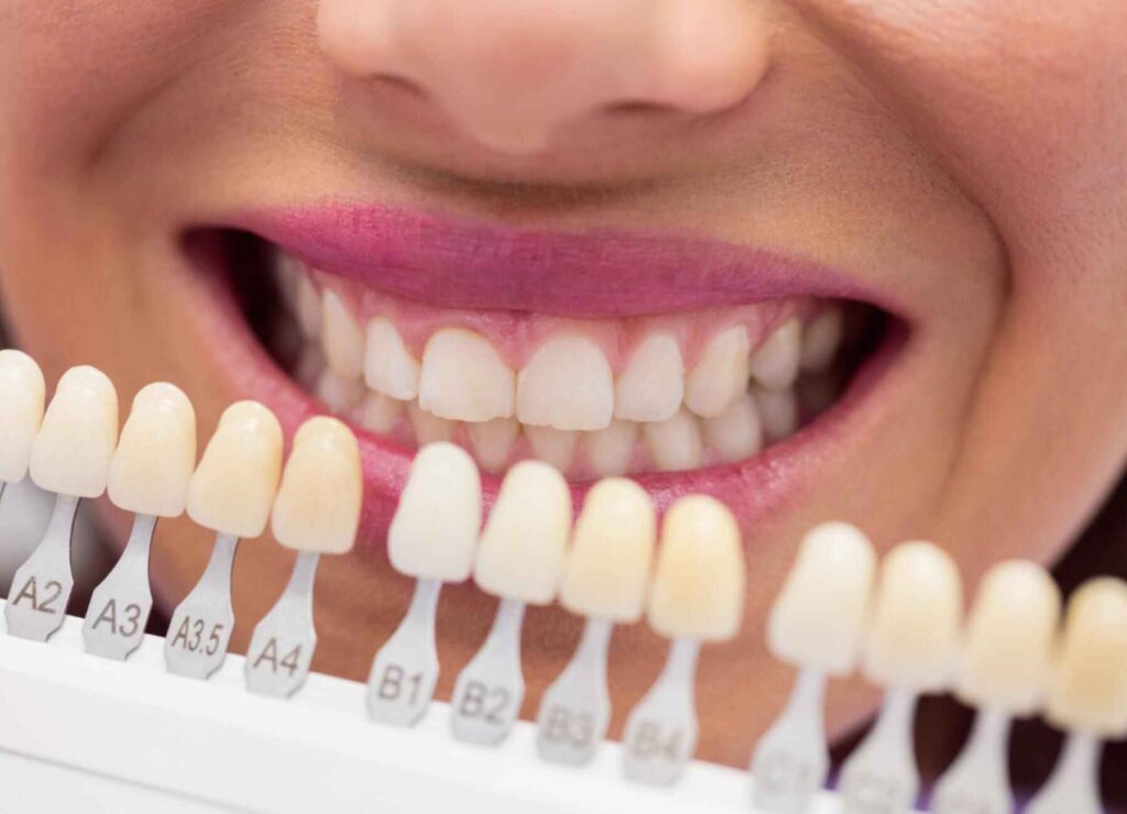How Veneer Width-to-Length Ratio Changes Smile Character
