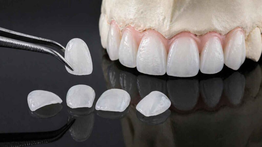 How Veneer Width-to-Length Ratio Changes Smile Character