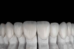 Perikymata in Veneers When Micro-Detail Adds Realism