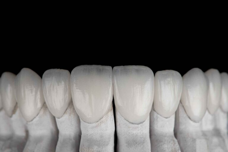 Perikymata in Veneers When Micro-Detail Adds Realism