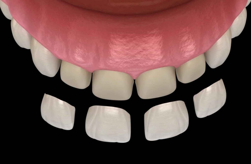 Perikymata in Veneers When Micro-Detail Adds Realism