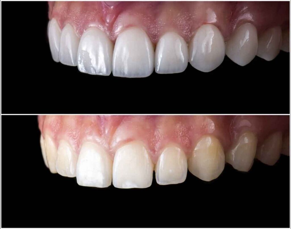 Perikymata in Veneers When Micro-Detail Adds Realism