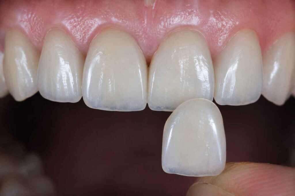 Replacing One Veneer in a Multi-Unit Case Shade and Texture Matching Strategies
