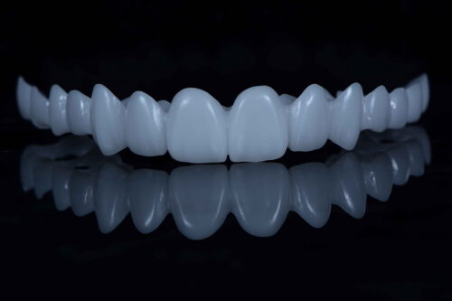 Snap on veneer