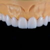 Snap on veneer Snap on veneer