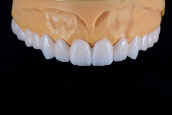 Snap on veneer Snap on veneer