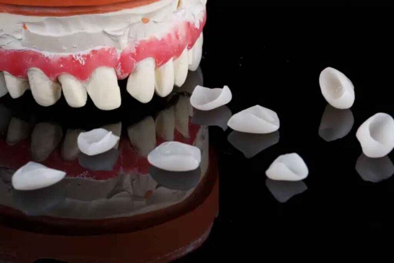 Ultra-Thin Veneers