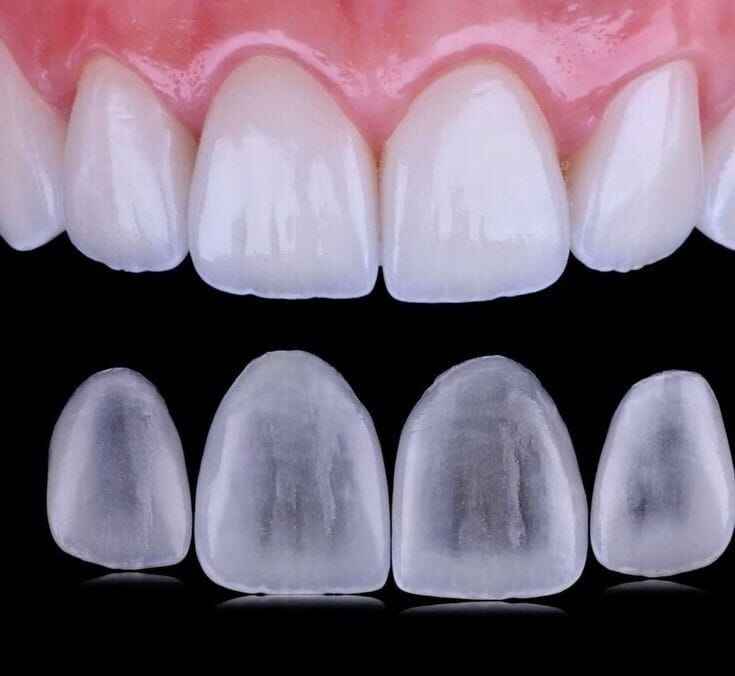 Ultra-Thin Veneers