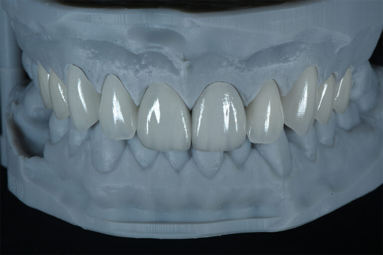 Veneer