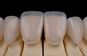 Veneer