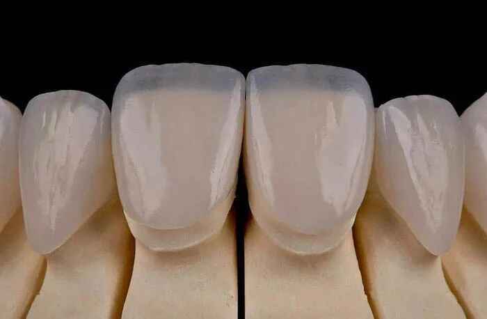 Veneer