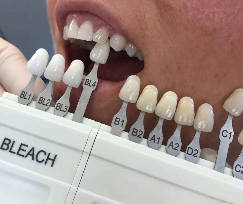 Veneer Esthetics
