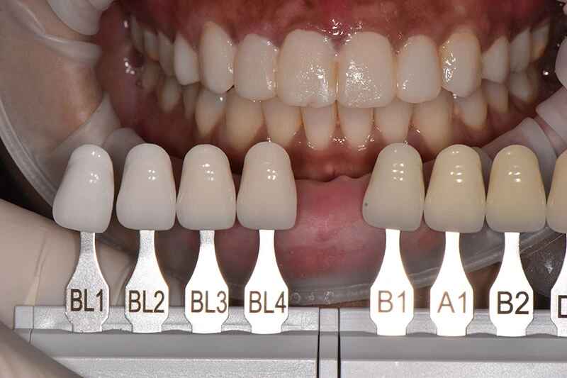 Veneer Esthetics
