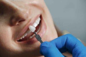 About Us 14 Veneers