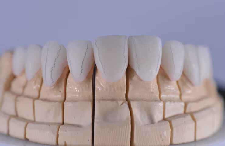 Veneers