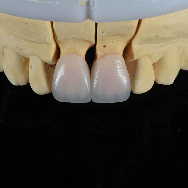 Veneers