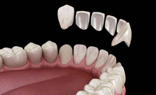 Surface Texture in Veneers: Matching Age, Expression, and Personality 3 베니어