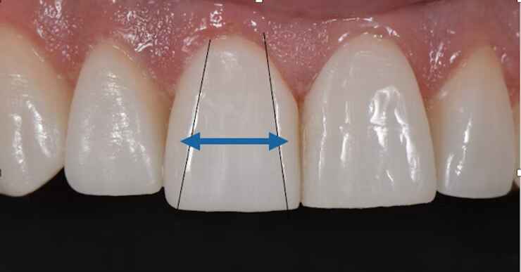 Veneers