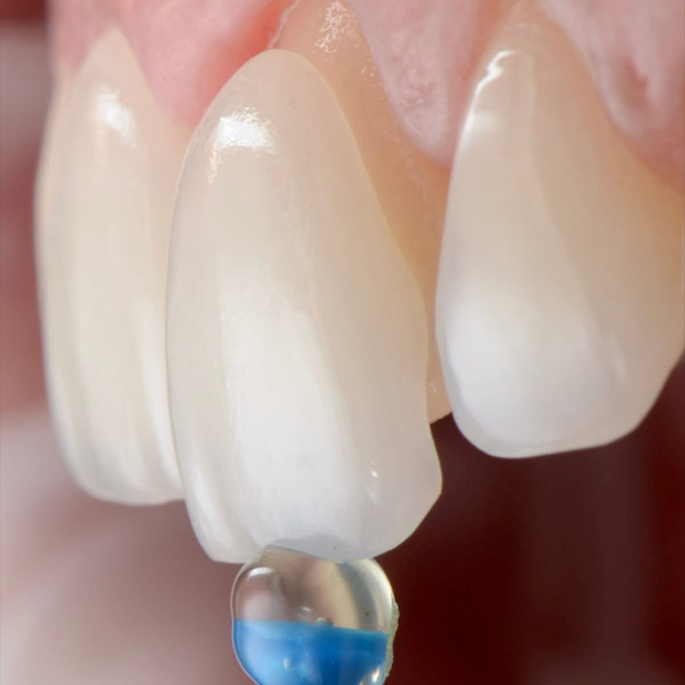 Veneers