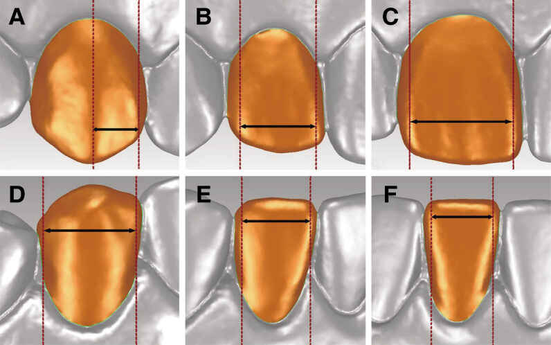 Veneers