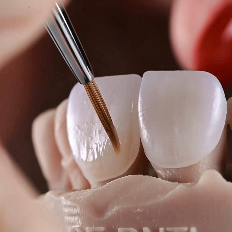 Veneers