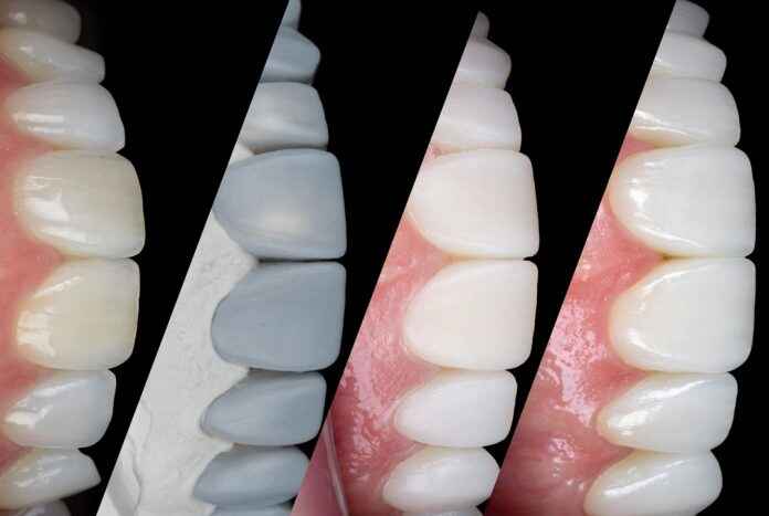Surface Texture in Veneers: Matching Age, Expression, and Personality 1 베니어