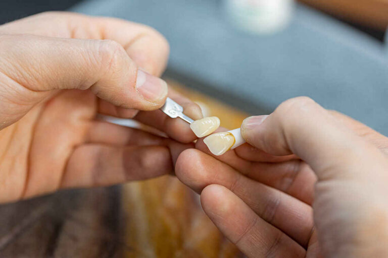Veneers