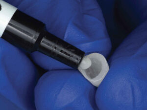When Should MDP Primer Be Used for Zirconia Crown Cementation