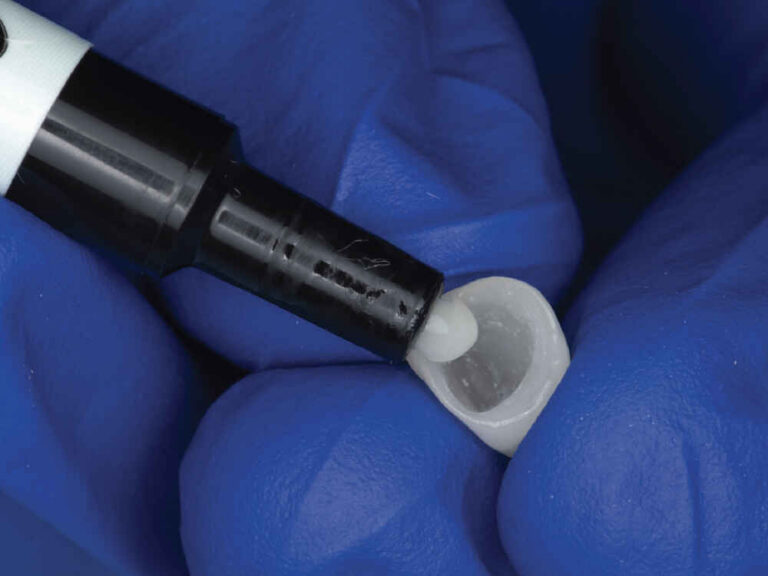 When Should MDP Primer Be Used for Zirconia Crown Cementation