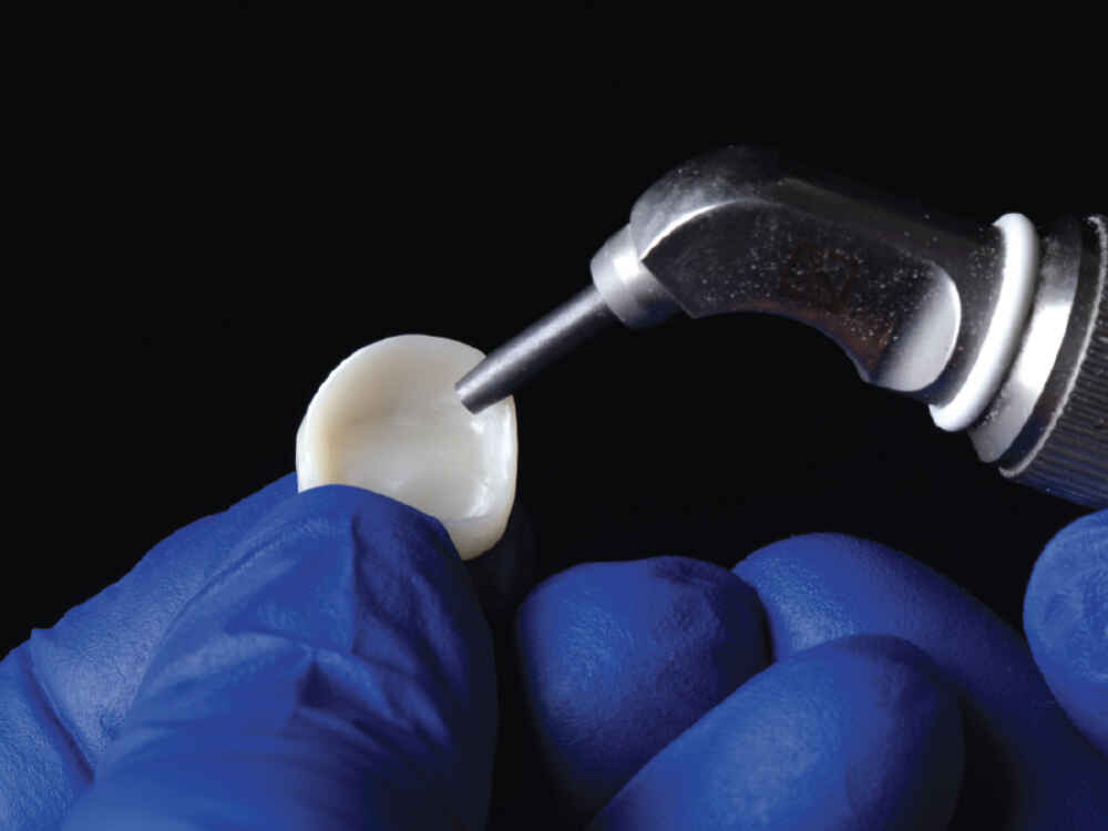 When Should MDP Primer Be Used for Zirconia Crown Cementation