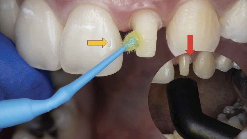 When Should MDP Primer Be Used for Zirconia Crown Cementation