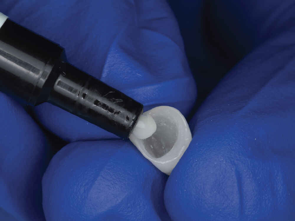 When Should MDP Primer Be Used for Zirconia Crown Cementation