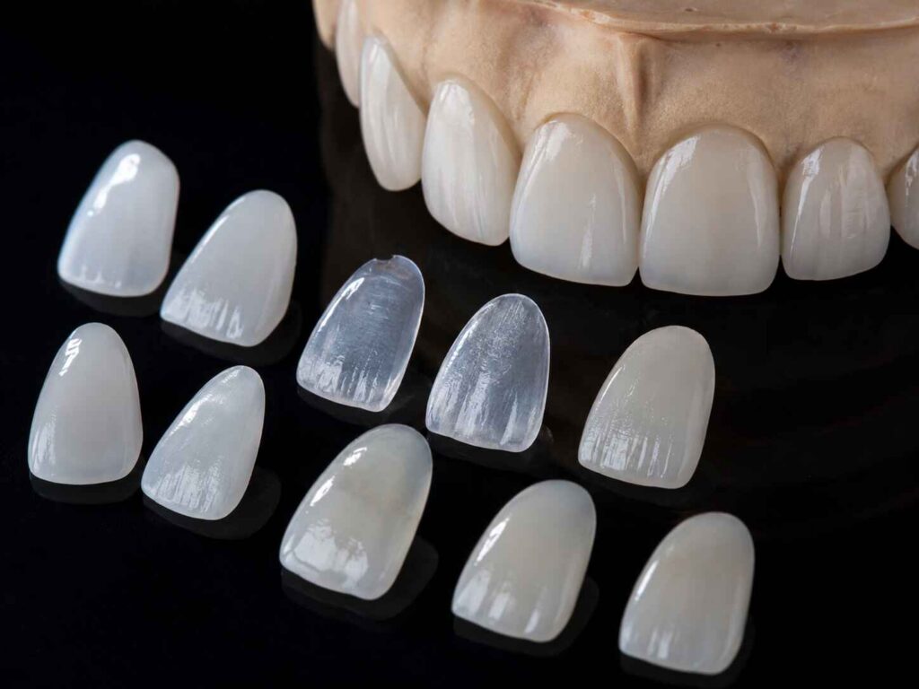 Which Veneer Material Offers the Best Control of Surface Texture