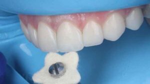 Adjusting Veneer Incisal Edges Without Destroying Surface Character