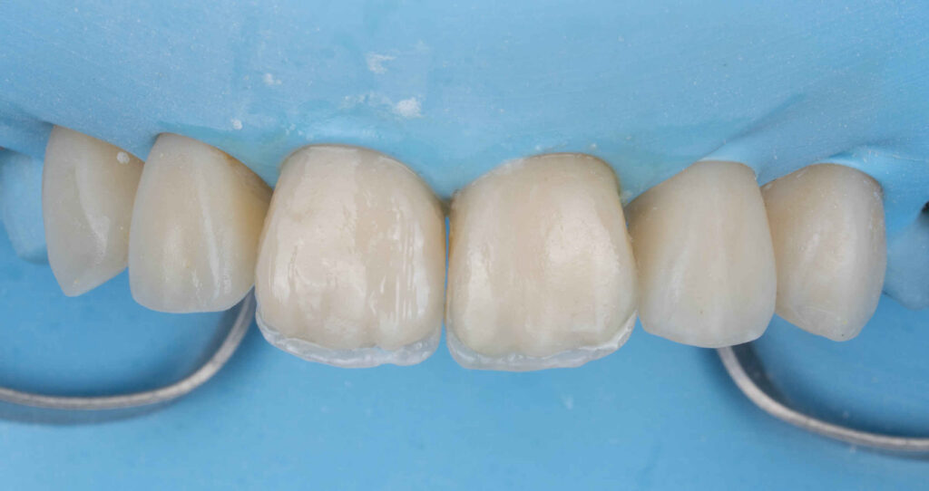 Adjusting Veneer Incisal Edges Without Destroying Surface Character