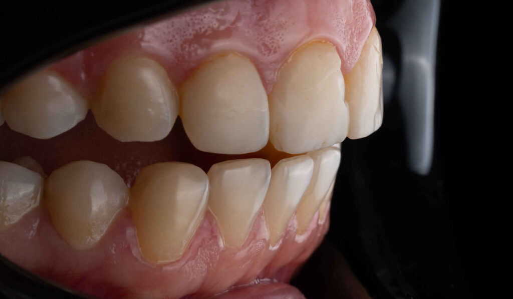 Adjusting Veneer Incisal Edges Without Destroying Surface Character