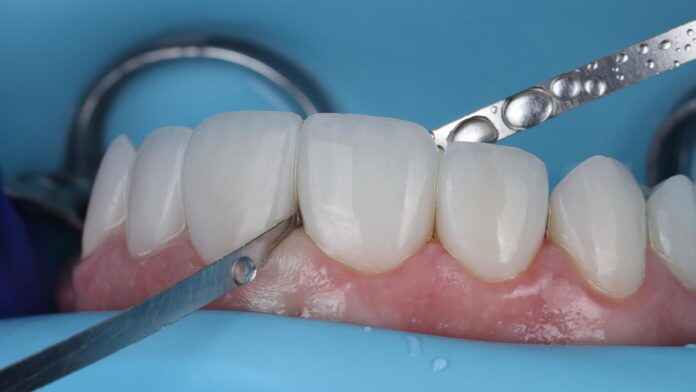 Adjusting Veneer Incisal Edges Without Destroying Surface Character